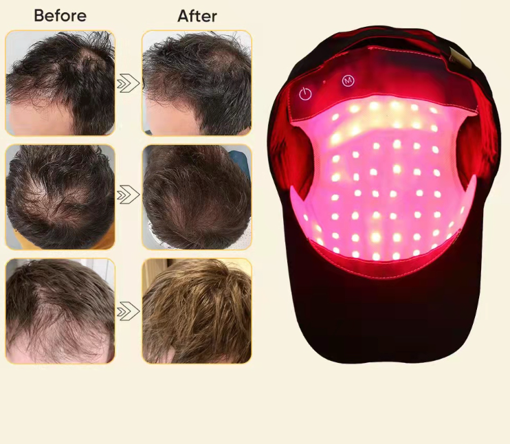 Laser Hair Cap, Scalp Treatment 